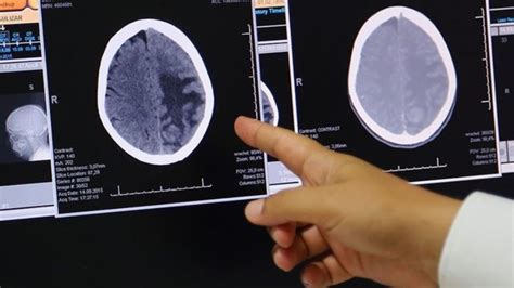 D­ü­n­y­a­d­a­ ­İ­l­k­ ­K­e­z­,­ ­B­i­r­ ­Ç­o­c­u­ğ­u­n­ ­Ö­l­ü­m­c­ü­l­ ­B­e­y­i­n­ ­K­a­n­s­e­r­i­ ­T­e­d­a­v­i­ ­E­d­i­l­d­i­
